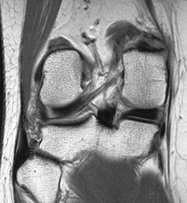 Figure 3 for case Partial tear of the tendon of the medial head of the gastrocnemius muscle ( RID2921 )